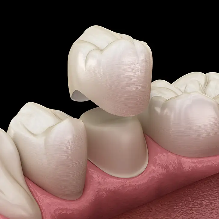 Illustration of dental crown being placed on back tooth