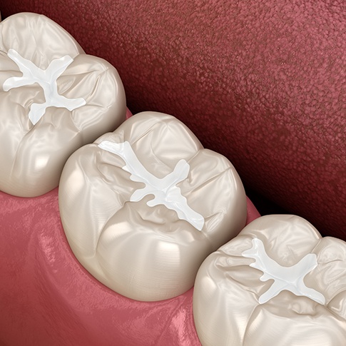 a 3D illustration of a dental sealant in a molar