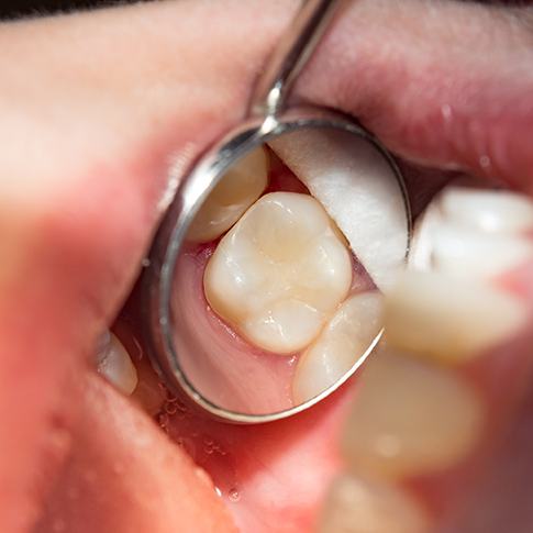 a closeup of a dental filling