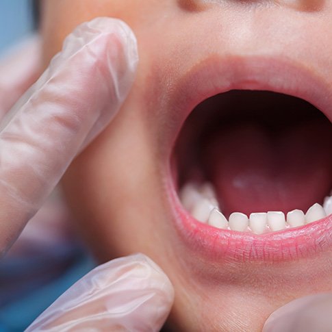 Dentist checking smile for dental sealants